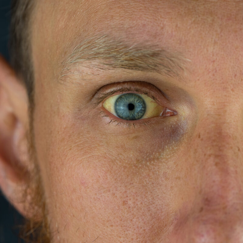 Olhos amarelados: o que pode ser essa condição?