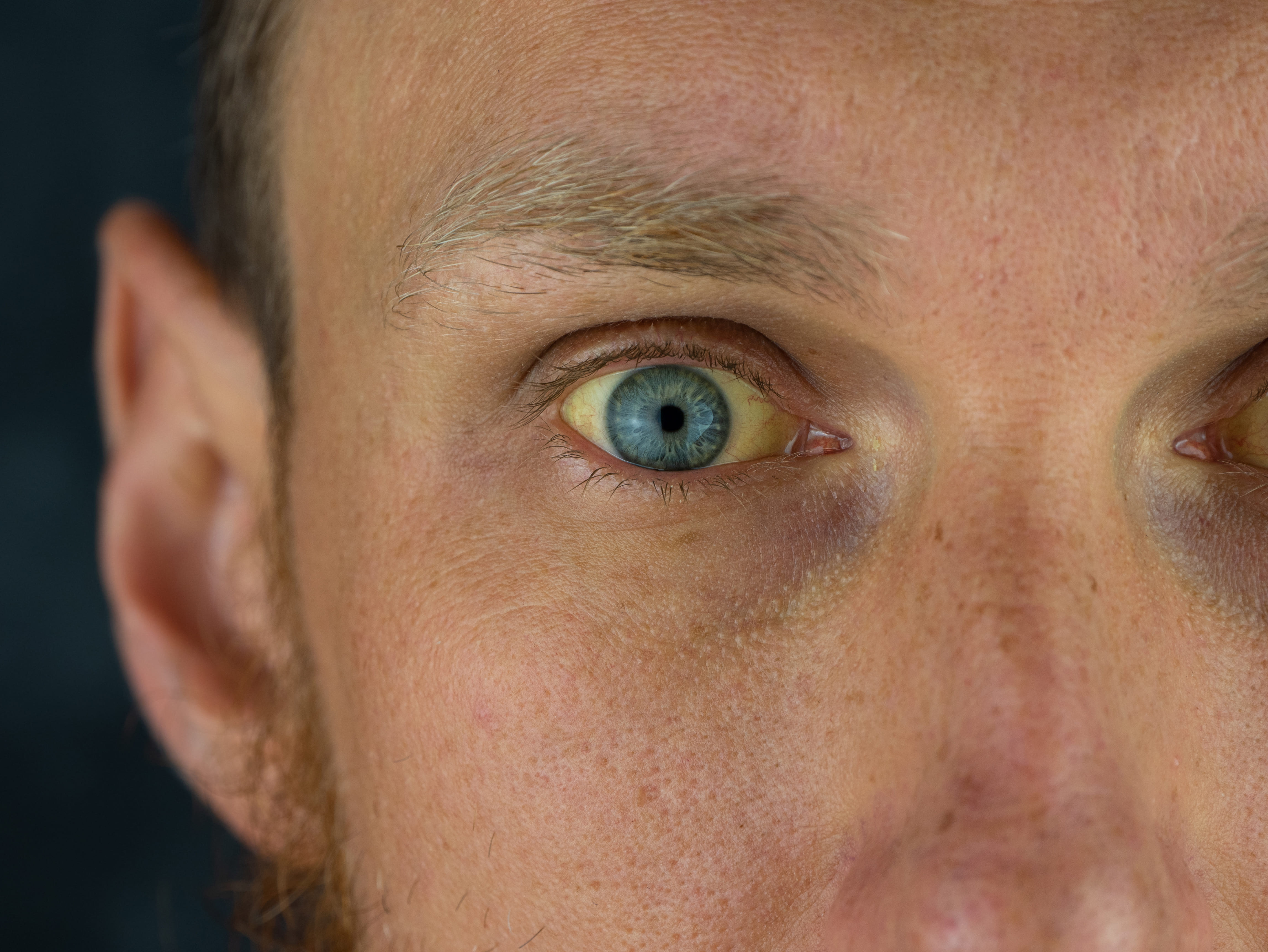 Olhos amarelados: o que pode ser essa condição?
